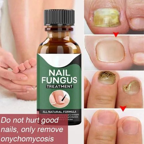 Nail Fungal Repair Serum | Nail fungas removal