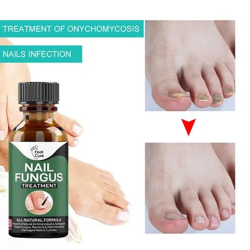 Nail Fungal Repair Serum | Nail fungas removal