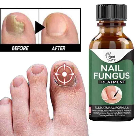 Nail Fungal Repair Serum | Nail fungas removal